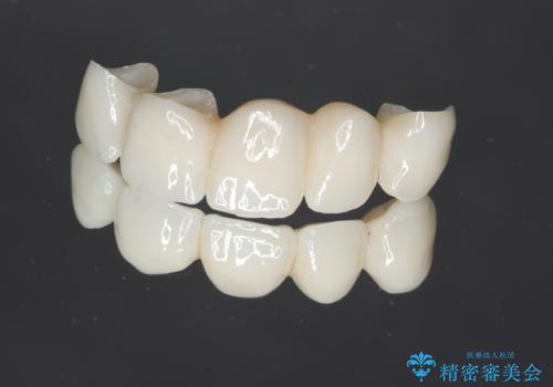 歯槽堤保存術を併用したブリッジ治療