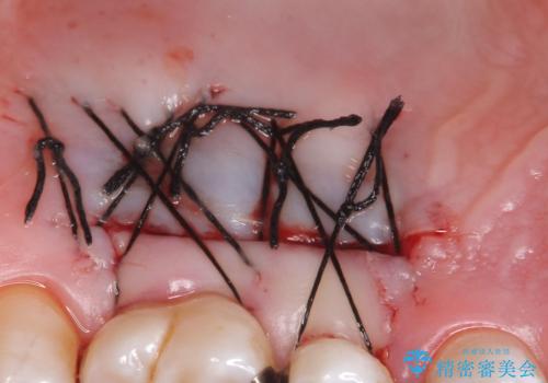 歯肉退縮に対する結合組織移植の治療後