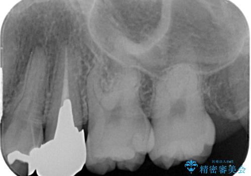 笑った時に目立つ銀歯を治したい　オールセラミッククラウンの治療前