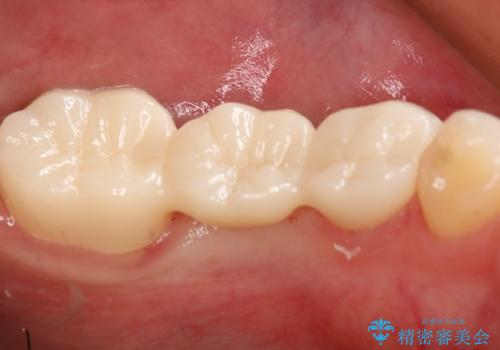 銀歯をやり変えたい フルジルコニアブリッジの治療後