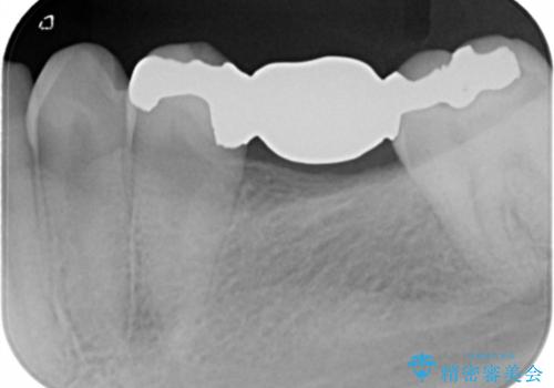 銀歯をやり変えたい フルジルコニアブリッジの治療前
