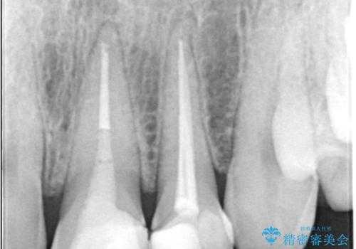 欠けて変色した前歯を一新!オールセラミックで叶える自然な笑顔の治療前