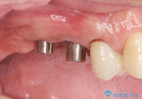 奥歯でしっかりと咬みたい 咬合機能をしっかりと回復するインプラント治療の治療中