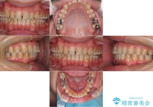 正中離開・クロスバイト・すきっ歯・叢生|インビザラインで治療の治療中