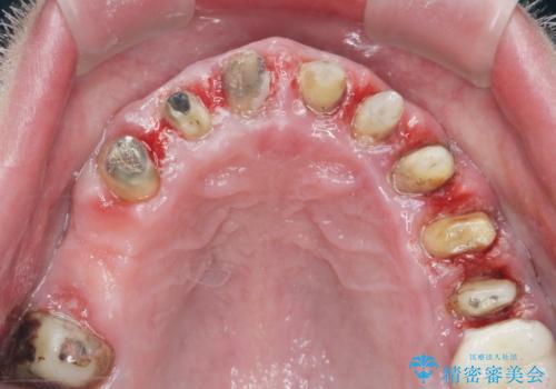 [ 歯周外科手術 ]  セラミック治療後の歯ぐきの違和感の治療前