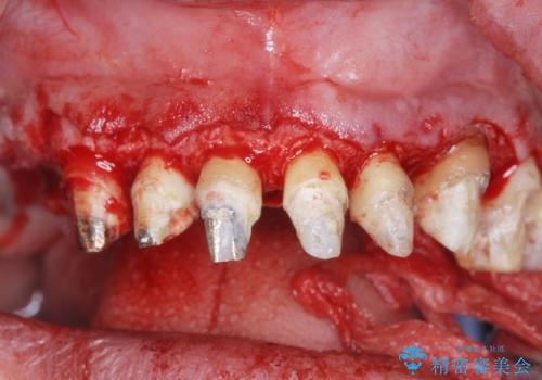 [ 歯周外科手術 ]  セラミック治療後の歯ぐきの違和感の治療中