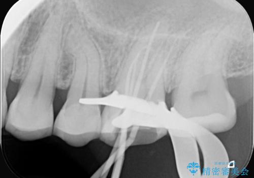 奥歯の痛みを根本から解消し、クラウンで歯の強度を回復の治療中