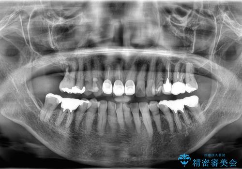 重度歯周病で失った奥歯2本を、抜歯即時インプラントで早期回復の治療前