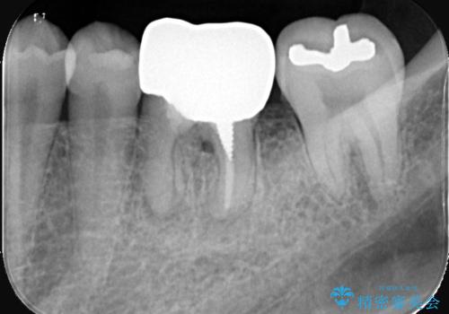 根尖性歯周炎|分岐部病変|パーフォレーション|インプラントで治療の治療前