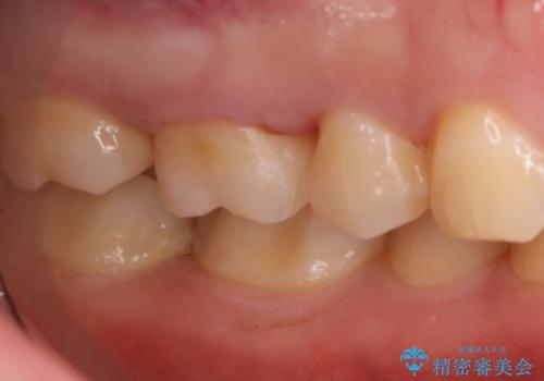 虫歯をしっかり治したい セラミックインレーの治療後