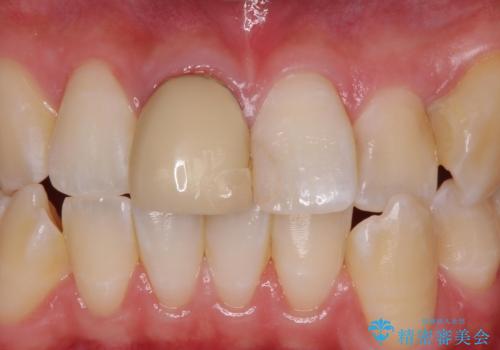 前歯の色が気になる。オールセラミッククラウンでのやり替えの治療前