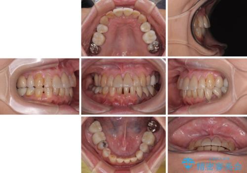 長年気になっていた前歯　矯正治療と補綴治療による審美歯科治療の治療後