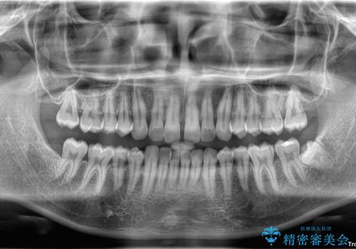 目立たない矯正で正中離開と下の前歯のデコボコを改善|インビザラインによる治療症例の治療前