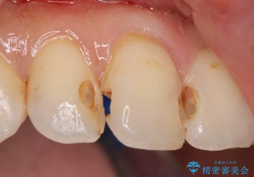 前歯の劣化したコンポジットレジン修復をセラミッククラウンへの治療中