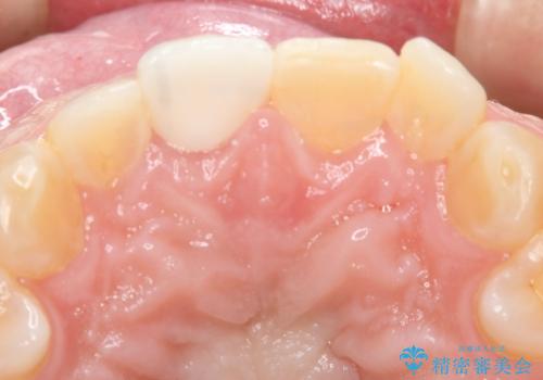 前歯が欠けたので綺麗にしたい　オールセラミッククラウンの治療後