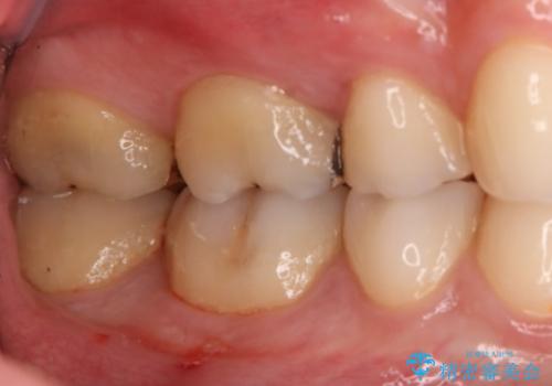奥歯の治療をしたい　セラミックインレーの治療前
