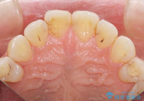 前歯の劣化したコンポジットレジン修復をセラミッククラウンへの治療前