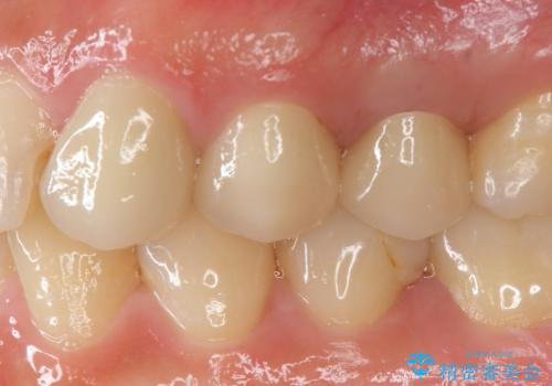 歯の水平・垂直的位置を整備したセラミッククラウン治療の症例 治療後