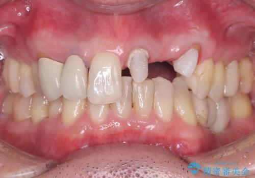 【セラミッククラウン】【エクストリュージョン】抜歯はしたくないの治療中