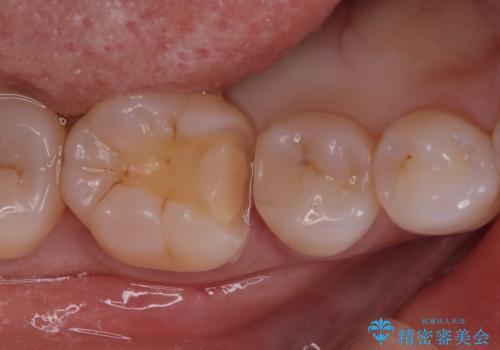 【セラミックインレー】歯がたまーにしみるの治療中