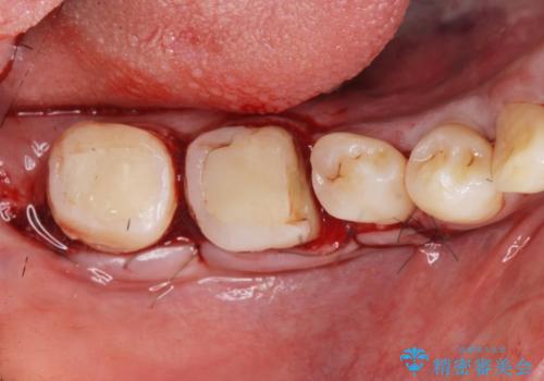 { 歯周外科 } 骨隆起除去を含む歯冠長延長術の治療中