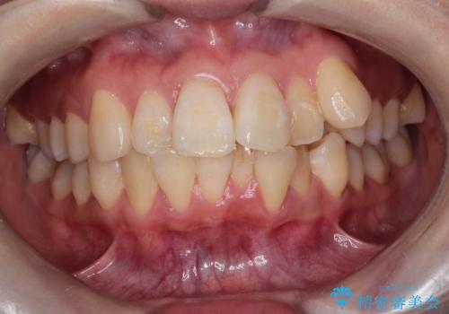 八重歯と正中のズレを解消!目立ちにくいワイヤー矯正で美しい歯並びへの治療前