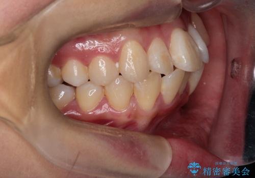 八重歯と正中のズレを解消!目立ちにくいワイヤー矯正で美しい歯並びへの治療前