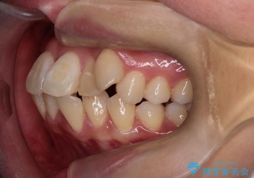 八重歯と正中のズレを解消!目立ちにくいワイヤー矯正で美しい歯並びへの治療前