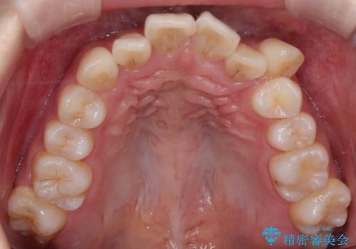 八重歯と正中のズレを解消!目立ちにくいワイヤー矯正で美しい歯並びへの治療前
