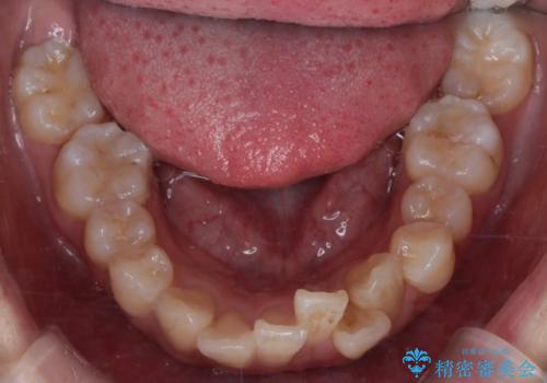 八重歯と正中のズレを解消!目立ちにくいワイヤー矯正で美しい歯並びへの治療前