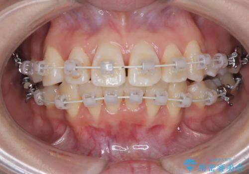 八重歯と正中のズレを解消!目立ちにくいワイヤー矯正で美しい歯並びへの治療中