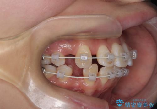 八重歯と正中のズレを解消!目立ちにくいワイヤー矯正で美しい歯並びへの治療中