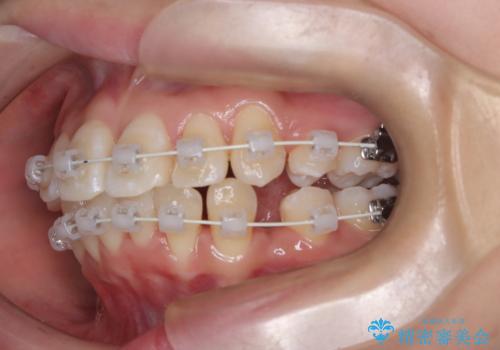 八重歯と正中のズレを解消!目立ちにくいワイヤー矯正で美しい歯並びへの治療中