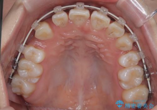 八重歯と正中のズレを解消!目立ちにくいワイヤー矯正で美しい歯並びへの治療中