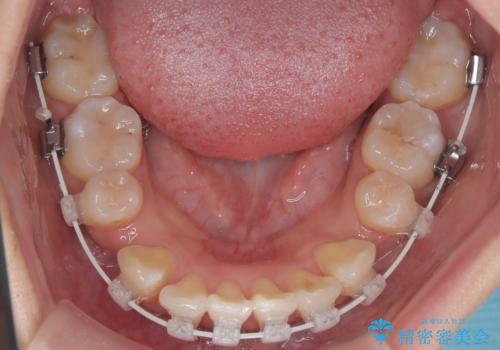 八重歯と正中のズレを解消!目立ちにくいワイヤー矯正で美しい歯並びへの治療中