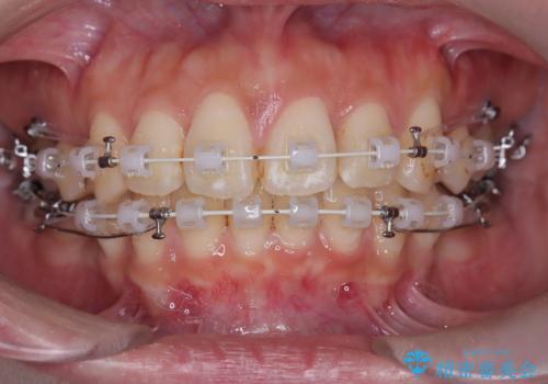 口元の突出感を解消し、横顔を美しく整えるワイヤー矯正の治療中