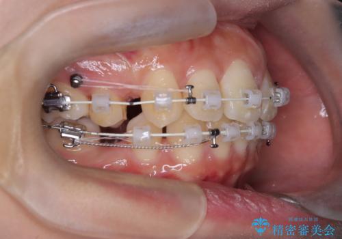 口元の突出感を解消し、横顔を美しく整えるワイヤー矯正の治療中