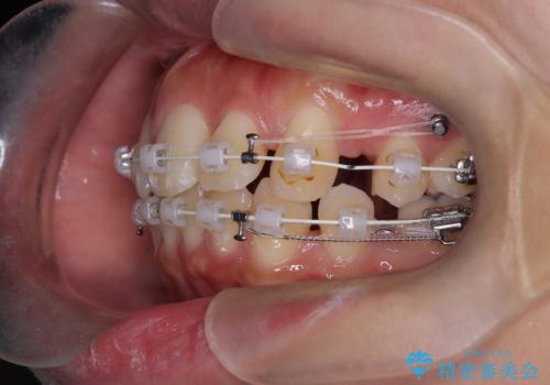 口元の突出感を解消し、横顔を美しく整えるワイヤー矯正の治療中