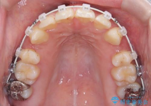 口元の突出感を解消し、横顔を美しく整えるワイヤー矯正の治療中