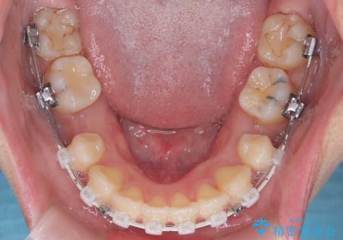 口元の突出感を解消し、横顔を美しく整えるワイヤー矯正の治療中