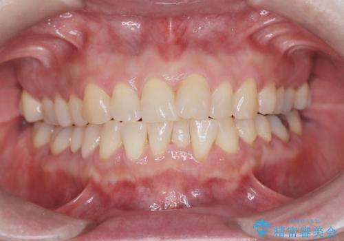 前歯の軽度なガタつきを、1年で美しく整える審美ワイヤー矯正の治療前