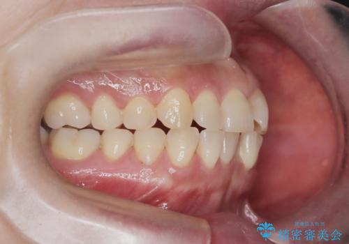 前歯の軽度なガタつきを、1年で美しく整える審美ワイヤー矯正の治療前