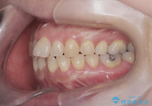 前歯の軽度なガタつきを、1年で美しく整える審美ワイヤー矯正の治療前