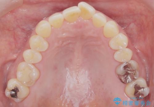 前歯の軽度なガタつきを、1年で美しく整える審美ワイヤー矯正の治療前