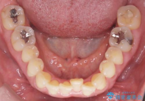 前歯の軽度なガタつきを、1年で美しく整える審美ワイヤー矯正の治療前