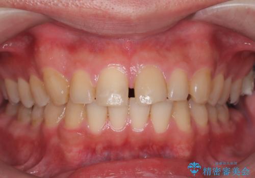 正中離開・クロスバイト・すきっ歯・叢生|インビザラインで治療の症例 治療前