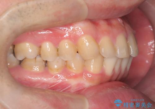 正中離開・クロスバイト・すきっ歯・叢生|インビザラインで治療の治療前