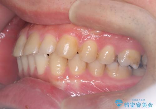 正中離開・クロスバイト・すきっ歯・叢生|インビザラインで治療の治療前