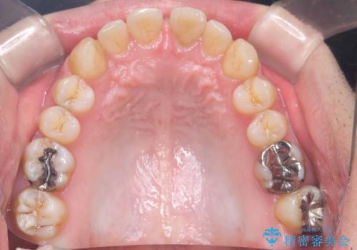 正中離開・クロスバイト・すきっ歯・叢生|インビザラインで治療の治療前