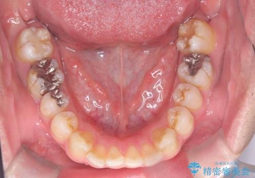 正中離開・クロスバイト・すきっ歯・叢生|インビザラインで治療の治療前